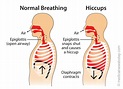 Hiccups: Causes and Treatments