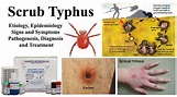 Mizoram Town in the Grip of Scrub Typhus - The Darjeeling Chronicle