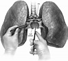 Bilateral Lung Transplantation - Operative Techniques in Thoracic and ...
