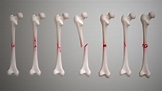 Fractures: Types, Symptoms, Causes and Treatment - Scientific Animations