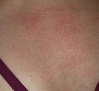 PMLE Sun Allergy Rash Pictures - Life Without Dressing