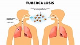 Early Warning Signs And Symptoms Of Tuberculosis - YouTube