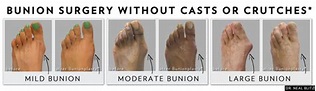 Walking After Bunion Surgery: Is It Possible? | HuffPost Life