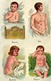 Childhood diseases, 19th Century illustration - Stock Image - C036/6578 ...