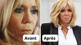 Brigitte Macron : Chirurgie esthétique ou non