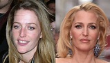 Gillian Anderson: Plastic Surgery, before and after