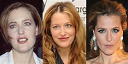 Gillian Anderson Plastic Surgery Before and After Pictures 2021