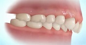 Tipos de Mordida y Malformaciones Dentarias