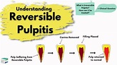 Reversible Pulpitis | Causes, Diagnosis and Treatment | Endodontics ...