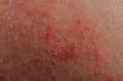 20 Types of Skin Lesions: Causes and Pictures