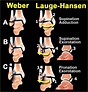 Ankle fracture - Weber and Lauge-Hansen Classification | Ankle fracture ...