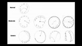 Researchers Assess Usefulness of Clock Drawing Cognitive Test in ...