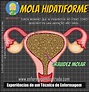 Mola Hidatiforme | Enfermagem Ilustrada