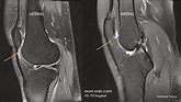 Ultimate Radiology : Hoffa's Fat Pad Impingement Syndrome