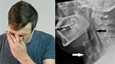 男捏鼻憋噴嚏後頸部爆痛 檢查驚見「氣管撕裂」成全球首例