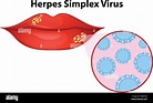 Diagrama que muestra el virus del herpes simple ilustración Imagen ...