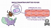 Rocky Mountain spotted fever (RMSF): Nursing - Osmosis Video Library