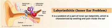 Labyrinthitis - Symptoms, Causes, Diagnosis, Treatment, Prognosis
