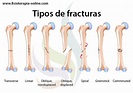 Fracturas óseas, tipos, cuidados y tratamiento | Fisioterapia Online
