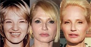 Ellen Barkin Facelift Plastic Surgery Before and After | Celebie