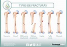 Fracturas óseas: Qué es, causas, síntomas, tratamiento y consejos ...