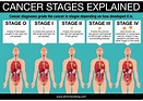 Dr Chris Nutting - Cancer Stages Explained