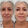 Full Face 🧡 Antes y después de un Rejuvenecimiento Facial