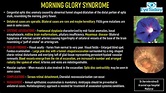 Morning Glory Syndrome - EyeToday