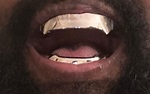 Kanye West shows off new Jaws-inspired teeth after getting '£670,000 ...