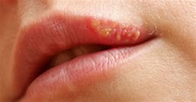 Herpes labial: causas y tratamiento ¿Sabes qué puede estar diciendo ...