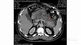 Valoración Tomografíca de Pancreatitis Aguda- Criterios de Baltazar ...