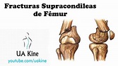 Fracturas Supracondileas de Fémur (Tratamiento) - YouTube