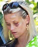 Reese Witherspoon bruised after car accident: Actress reveals black eye ...