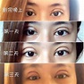更Q&A)#圖 割雙眼皮一年多心得👁 - 美妝板 | Dcard