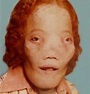 10 Heart-Rending Facts About Rocky Dennis, Whose Rare Deformity Was The ...