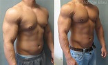 Bodybuilder Gynecomastia - Before and After Photos ⋆ Gynecomastia USA