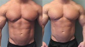 Bodybuilders with Gynecomastia - Surgery by Dr. Blau gynecomastia ...