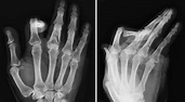 Fingers fractures: resolution through cannulated screws