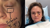Woman, 24, recovering from skin cancer on face after she thought it was ...
