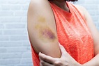 How Do You Know When a Bruise is Serious? | State Urgent Care