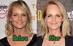 Helen Hunt Plastic Surgery: Facelift, Fillers, Before And After Photos ...