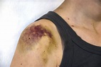 Bruises: Symptoms, Causes, Diagnosis, Treatment, Remedies