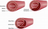 Spontaneous Coronary Artery Dissection Heart - vrogue.co