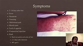 Rocky Mountain Spotted Fever - YouTube
