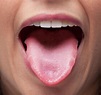 Tongue Disorders: MedlinePlus