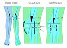 Distal Femoral Osteotomy | Valgus Knee Malalignment | Sugar Land ...