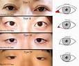 Eyelid Surgery by Prof Dr CN CHUA 蔡鐘能: Doc, Do I Need Operation on My ...