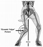 File:Dynamic knee valgus.png - Physiopedia