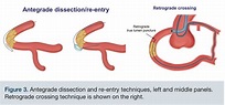 A Primer on Chronic Total Occlusion (CTO) Percutaneous Coronary ...