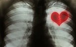 Medic-ALL : The Broken Heart Syndrome